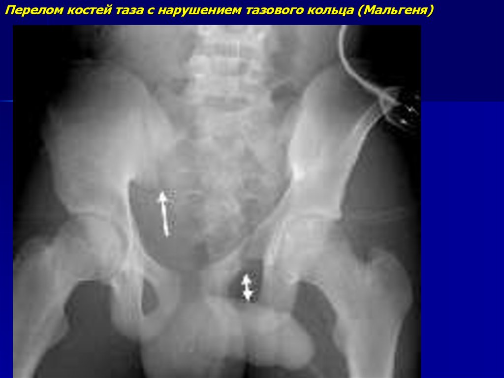 Разрыв крестцов. Перелом Мальгеня таза рентген. Перелом Мальгеня рентген. Перелом подвздошной кости таза рентген. Краевые переломы костей таза рентген.