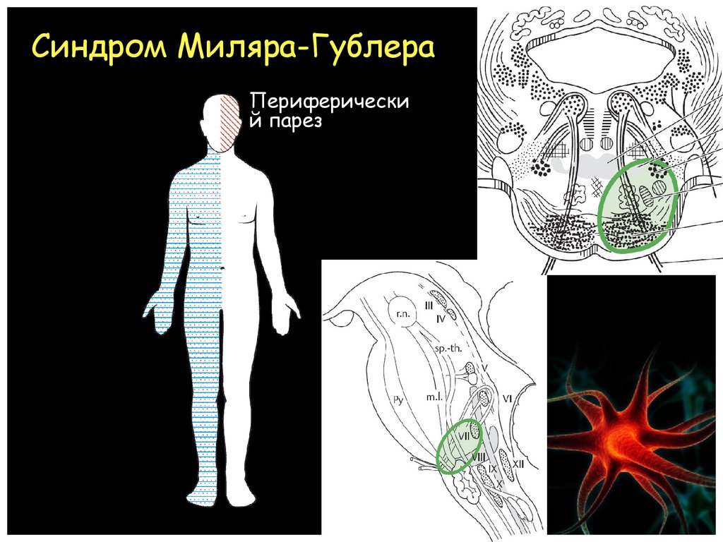 Синдром мийяра гюблера. Мийяра Гюблера. Альтернирующий синдром Мийяра-Гублера. Синдром Мийяра Гюблера Жюбле. Синдром Мийяра Гюблера неврология.