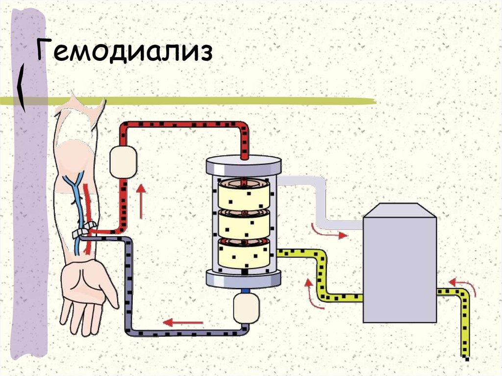 Диализ схема проведения