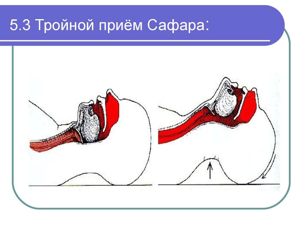 Тройной прием сафара картинки