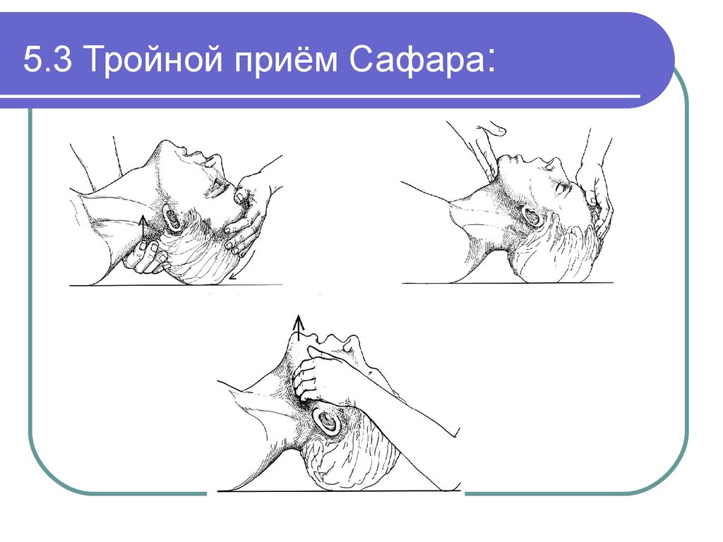 Прием сафара. Тройной прием Сафара алгоритм. Тройной прием Сафара у детей. Тройной прием Сафара на фантоме. Порядок проведения приема Сафара.