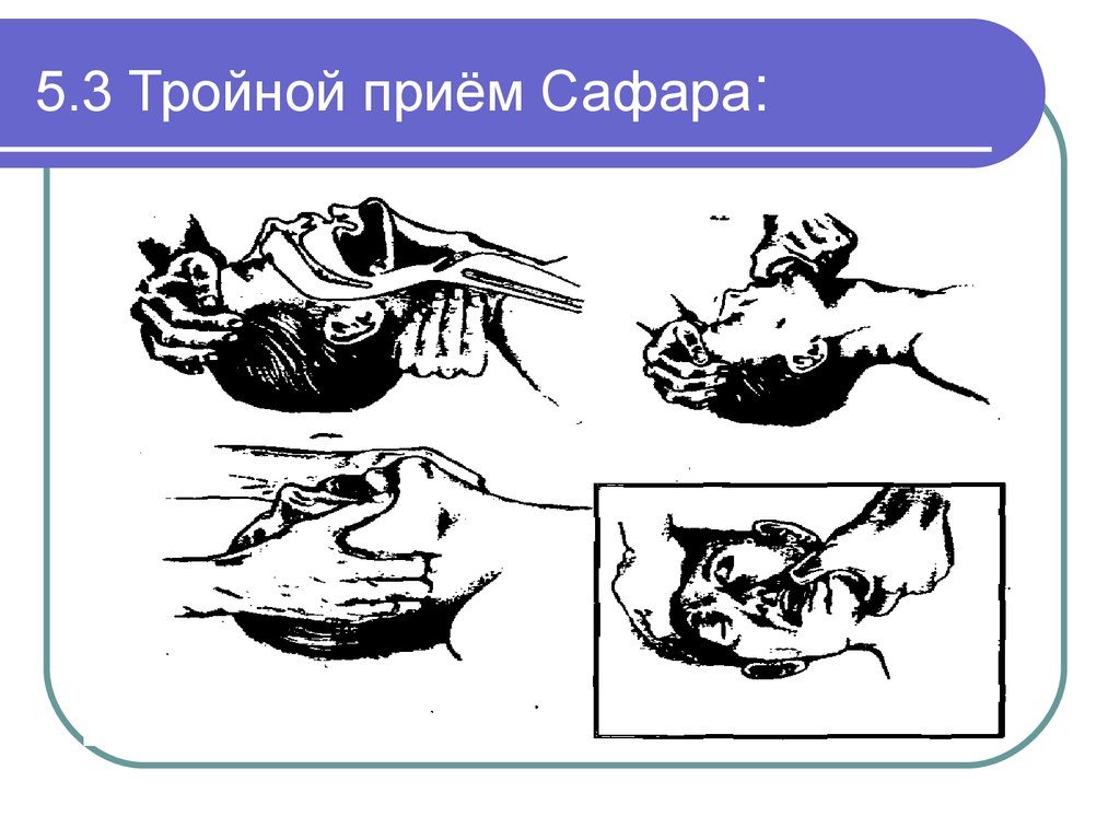 Тройной прием сафара. Тройничный прием Сафара. Петер Сафара тройной прием. Компоненты тройного приема Сафара. Тройной прием Сафара предназначен для.