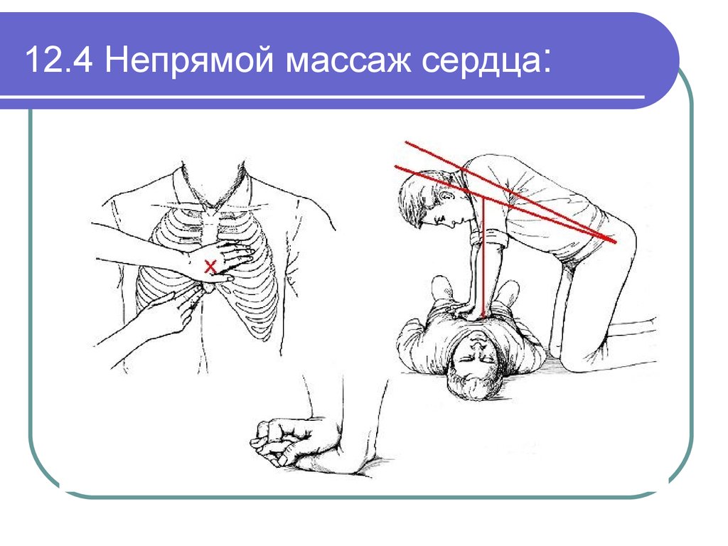 Презентация прямой массаж сердца