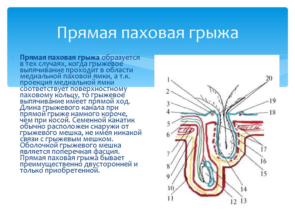 Косая паховая грыжа фото