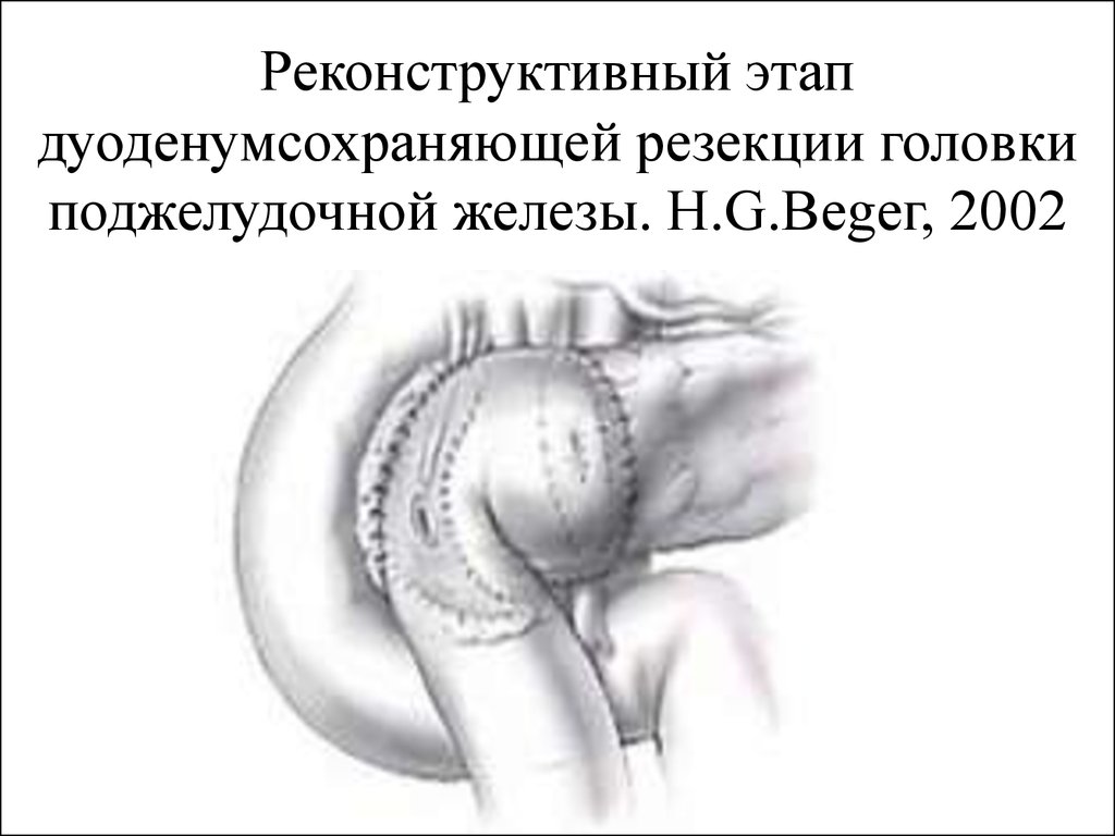 Операция головки поджелудочной железы