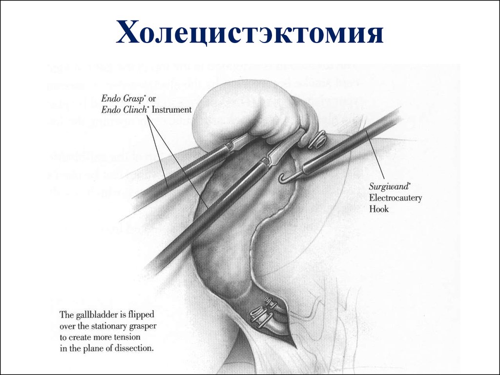 Операция желчнокаменной болезни