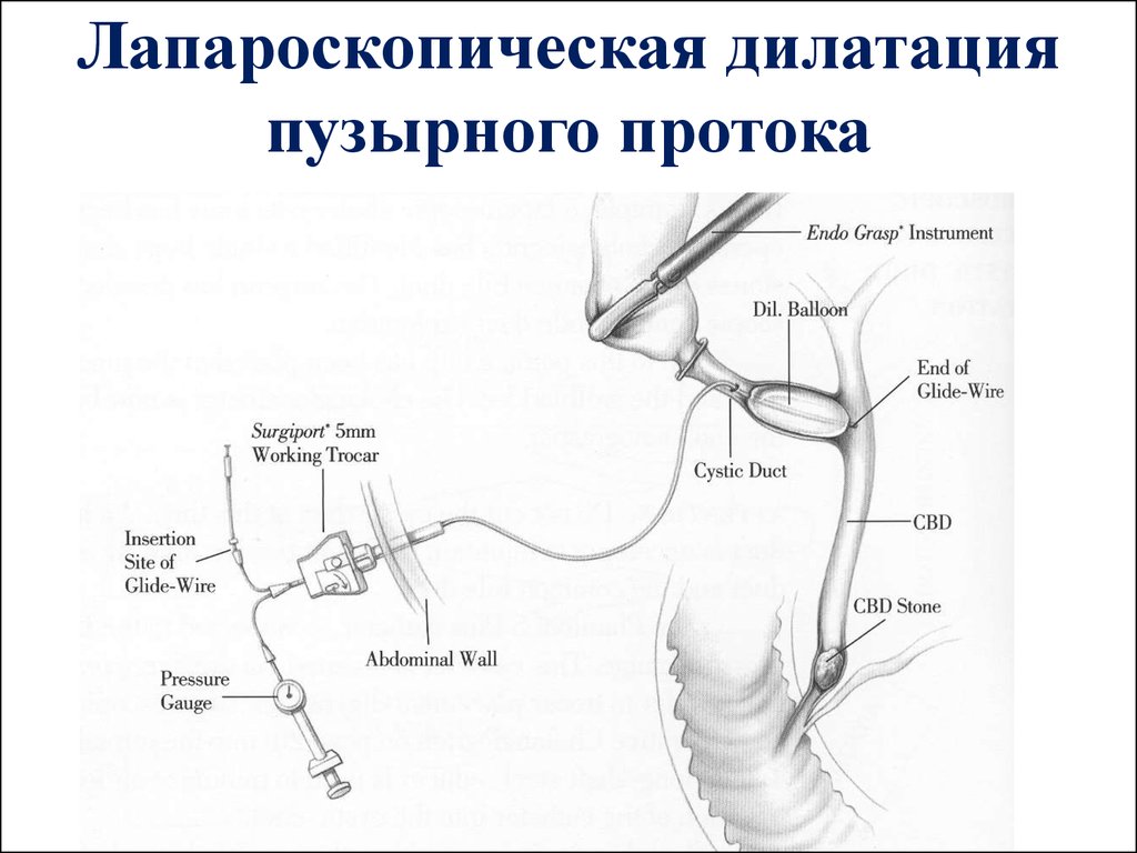 Холедох 4 мм