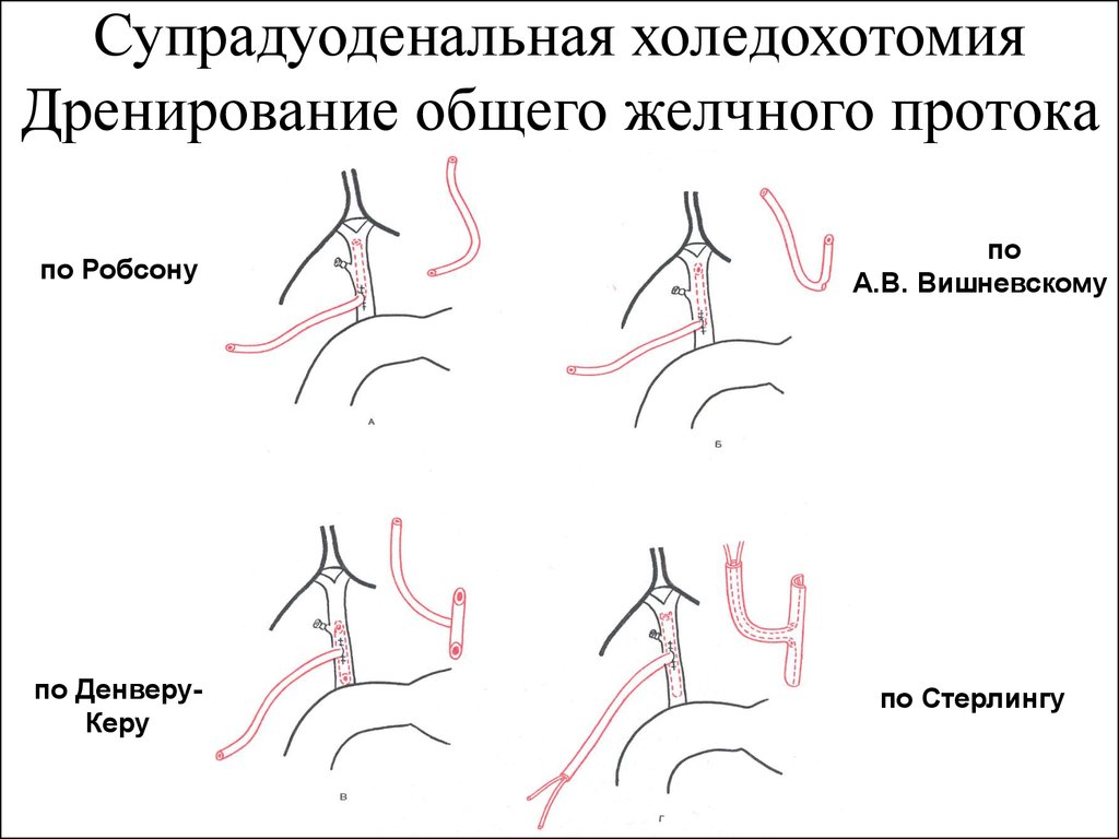 Наводящих путей. Дренирование желчных протоков. Лренированиежелчных протоков. Способы дренирования общего желчного протока. Наружное дренирование желчного протока по керу.