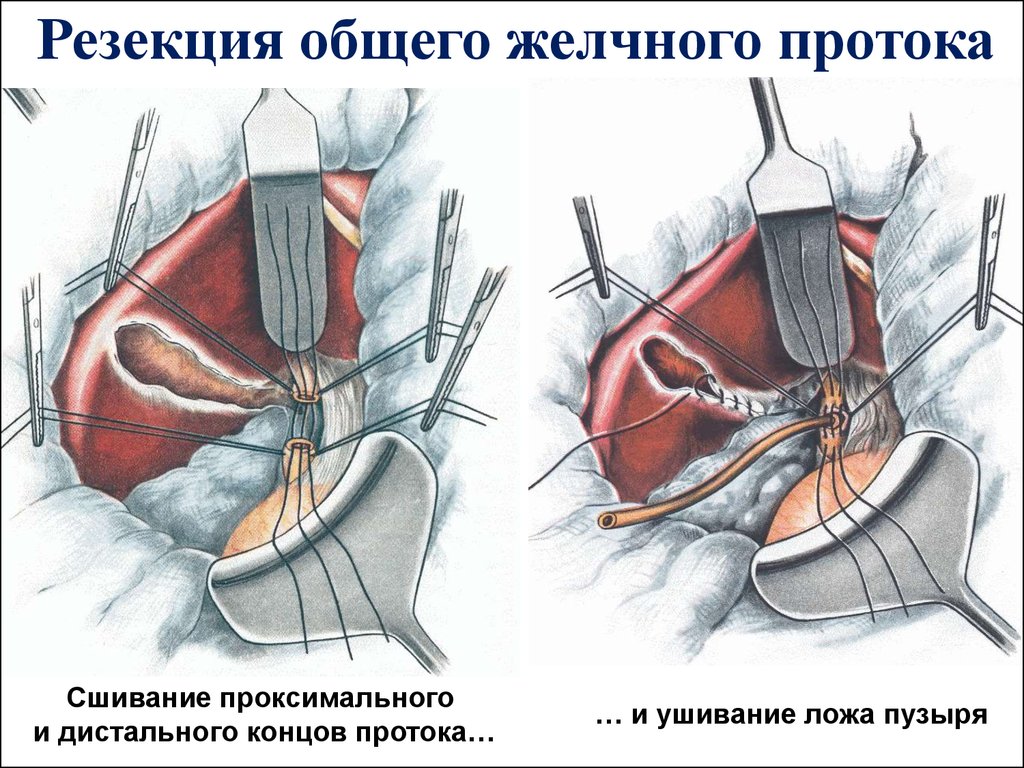 Резекция печени. Резекция печени топографическая анатомия. Ушивание ложа желчного пузыря. Резекция внепеченочных протоков. Резекция желчных протоков.