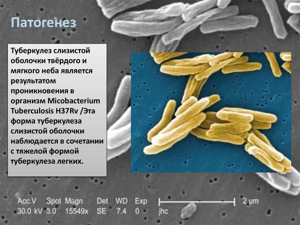 Туберкулез патогенез. Туберкулез слизистой оболочки. Патогенез туберкулеза животных. Туберкулез слизистых этиология.. Туберкулез слизистых оболочек.