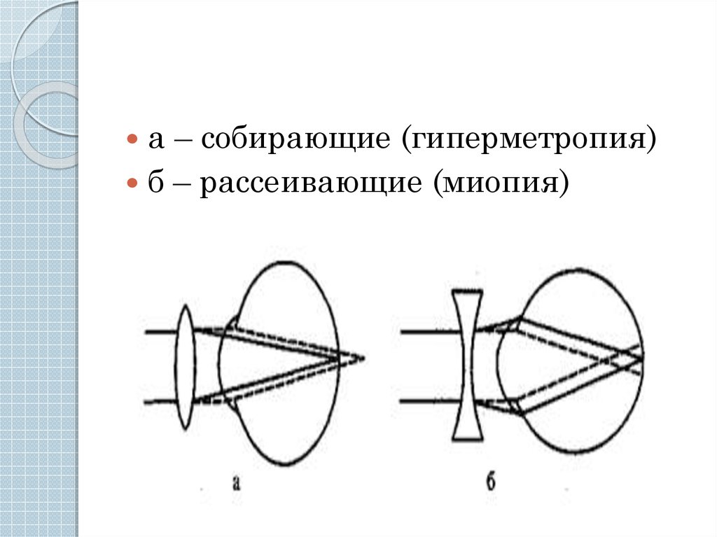 Обследование зрительных функций. Гиперметропия это в офтальмологии. Миопия и гиперметропия. Осевая гиперметропия. Рефракция офтальмология презентация.