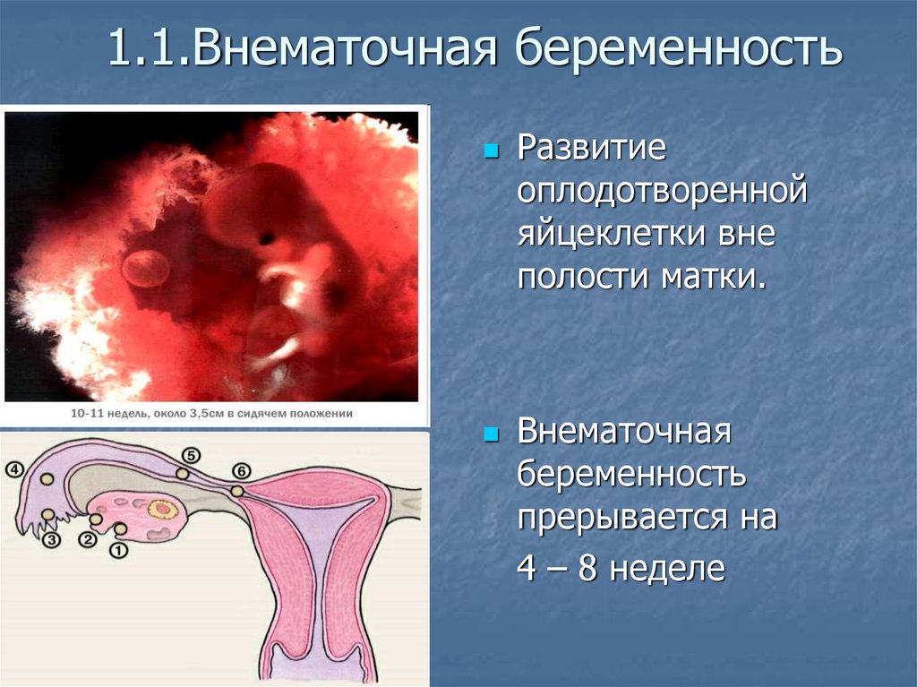 Можно забеременеть с полипом в матке. Внематочная беременность зародыш. Внематочная (эктопическая) беременность. Внематочная беременность в маточной трубе. Профилактика внематочной беременности.
