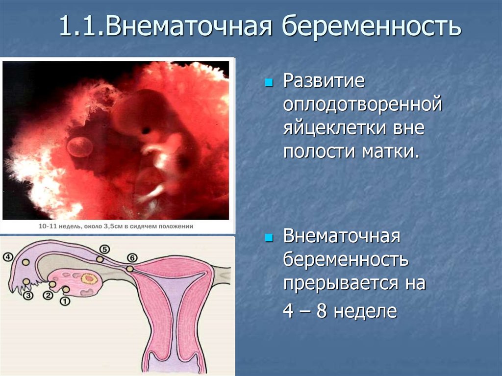 На каком сроке внематочной. Внематочная беременность. Внематочная (эктопическая) беременность. Профилактика внематочной беременности. Внематочная беременность симптомы.