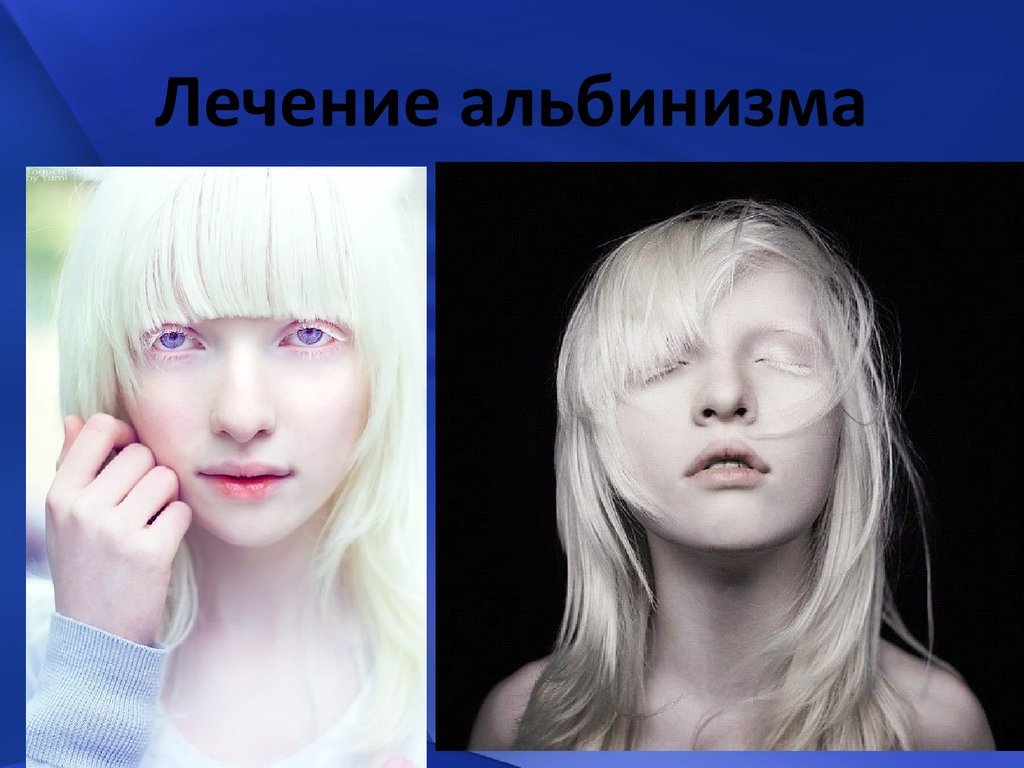 Альбинизмом страдают. Альбинизм патофизиология.
