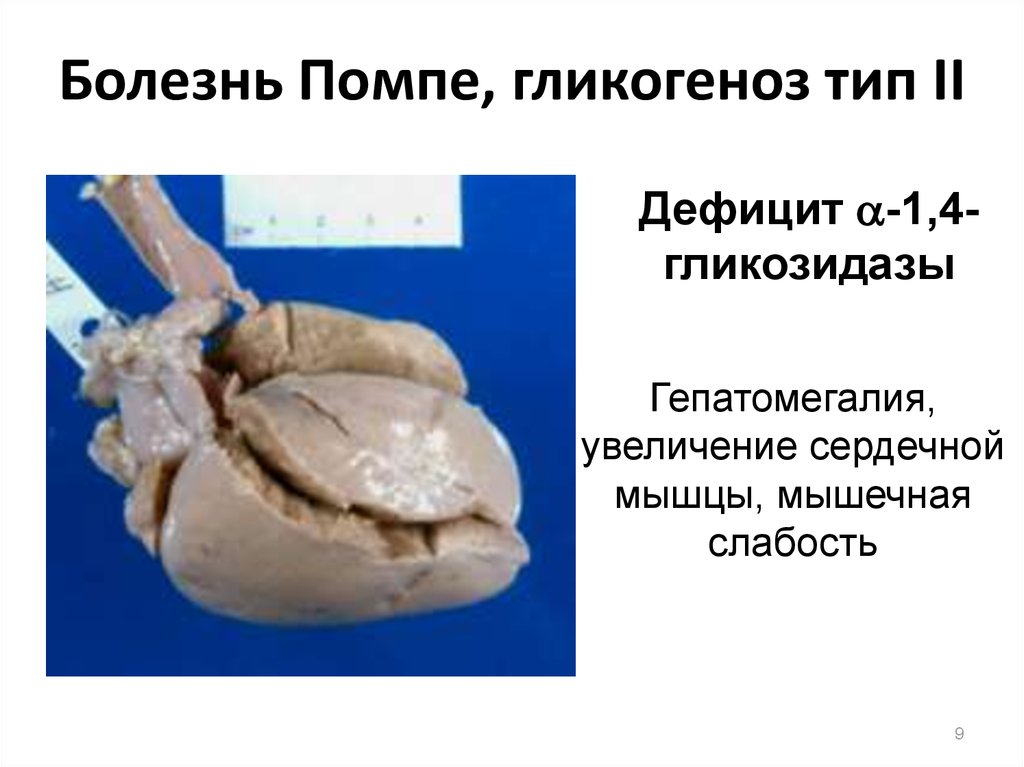 Болезнь Помпе, гликогеноз тип II