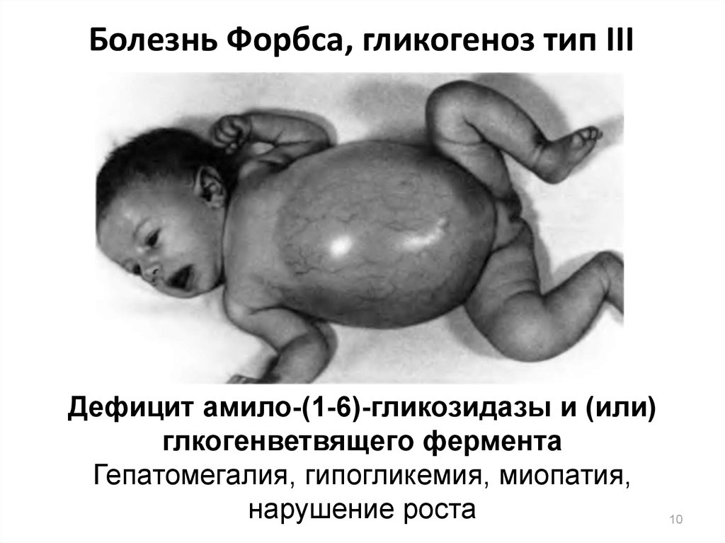 Болезнь Форбса, гликогеноз тип III