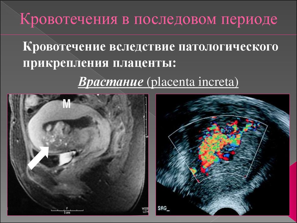 Кровотечение в периодах