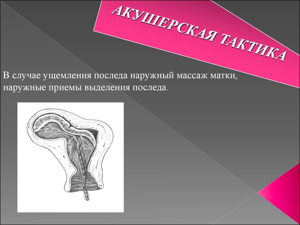 Наружная приемы. Ущемление отделившегося последа. Тактика при ущемлении последа. Причины ущемления последа.