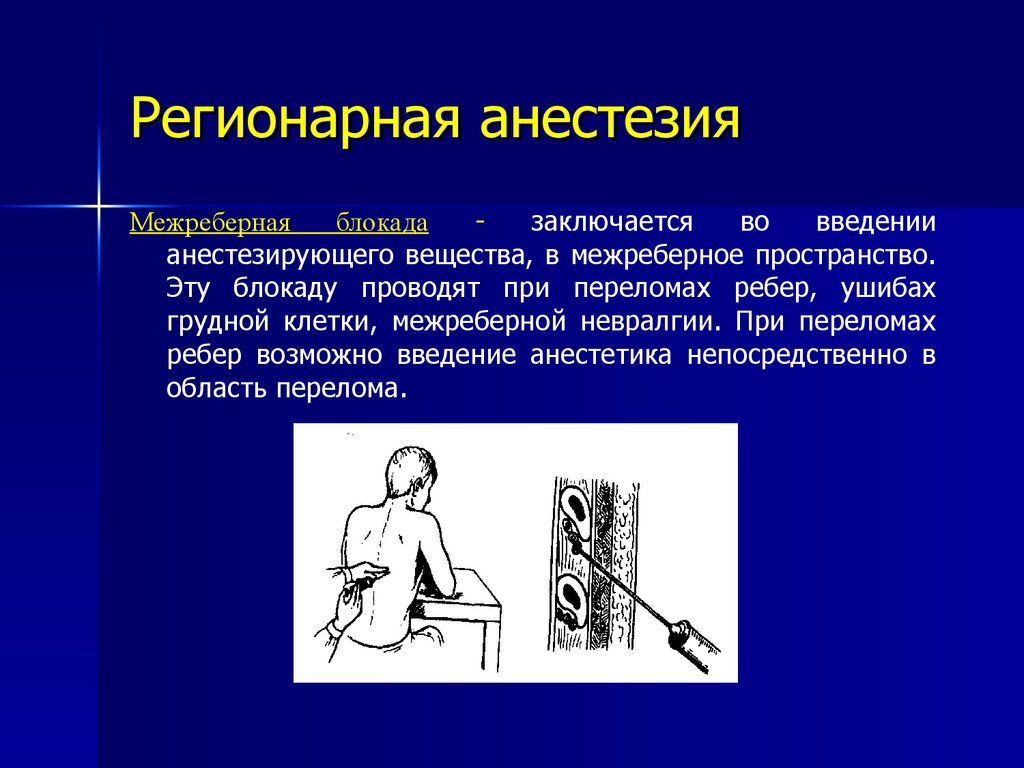 Регионарная анестезия у детей презентация