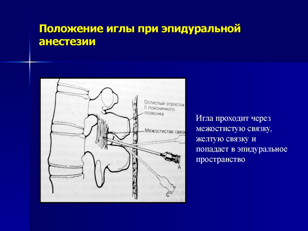 Схема эпидуральной анестезии