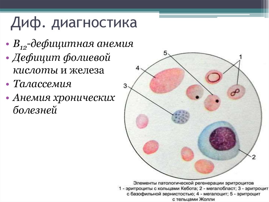 Дефицитная анемия. Тельца Жолли железодефицитной анемии. Анизоцитоз, пойкилоцитоз, тельца Жолли, кольца Кебота. Талассемии кольца Кебота. Мегалоцит.