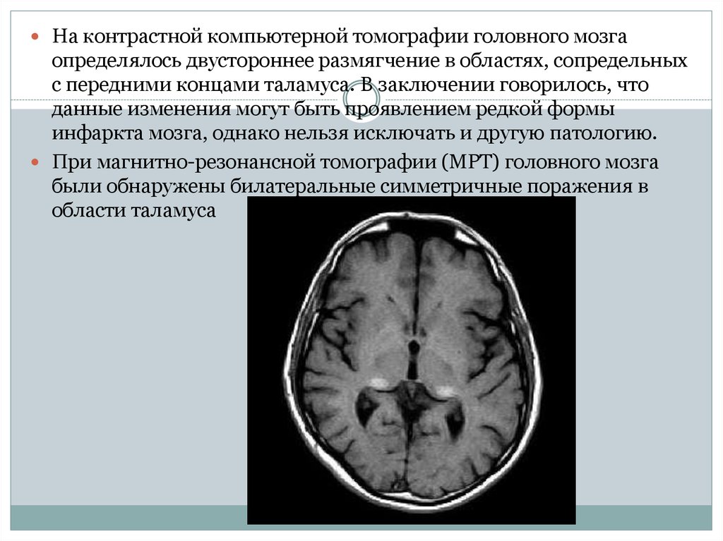 Ишемические изменения головного мозга. Ишемический инсульт мрт. Кт головного мозга ретроцеребеллярная. Кт мозга при ДЦП. Ишемический ОНМК мрт.