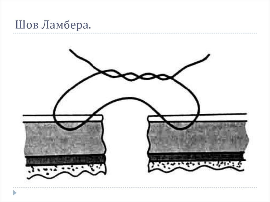 Шов Ламбера.