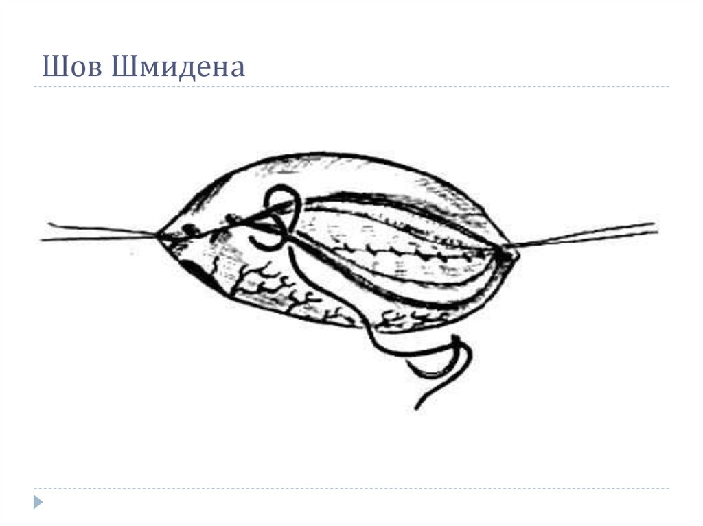 Шов Шмидена