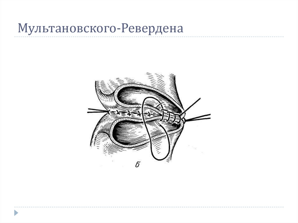 Шов мультановского схема