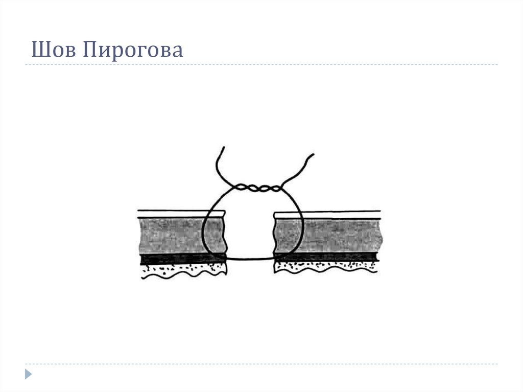 Швах. Двухрядный шов Пирогова черни. Шов Пирогова Матешука. Кишечный шов Пирогова черни. Кишечный шов Пирогова Матешука.