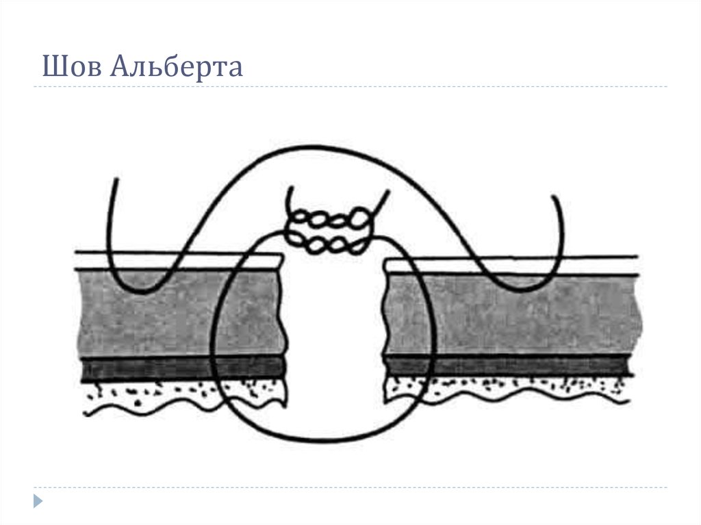Шов Альберта