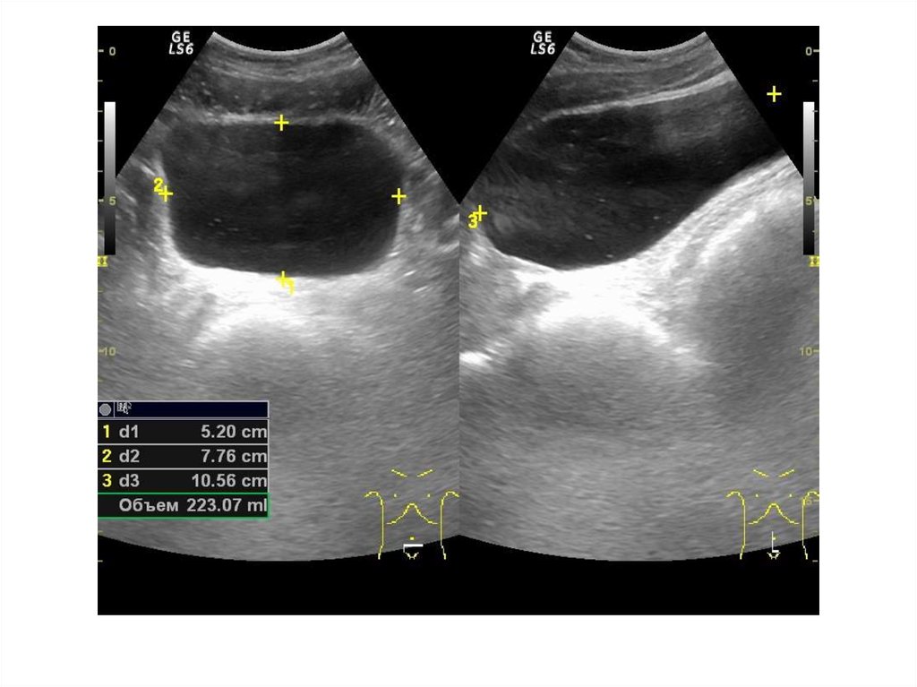 Узи мочевого пузыря. Измерение мочевого пузыря на УЗИ. Объем мочевого пузыря УЗИ. Измерение объема мочевого пузыря по УЗИ. Объем мочевого пузыря на УЗИ норма.