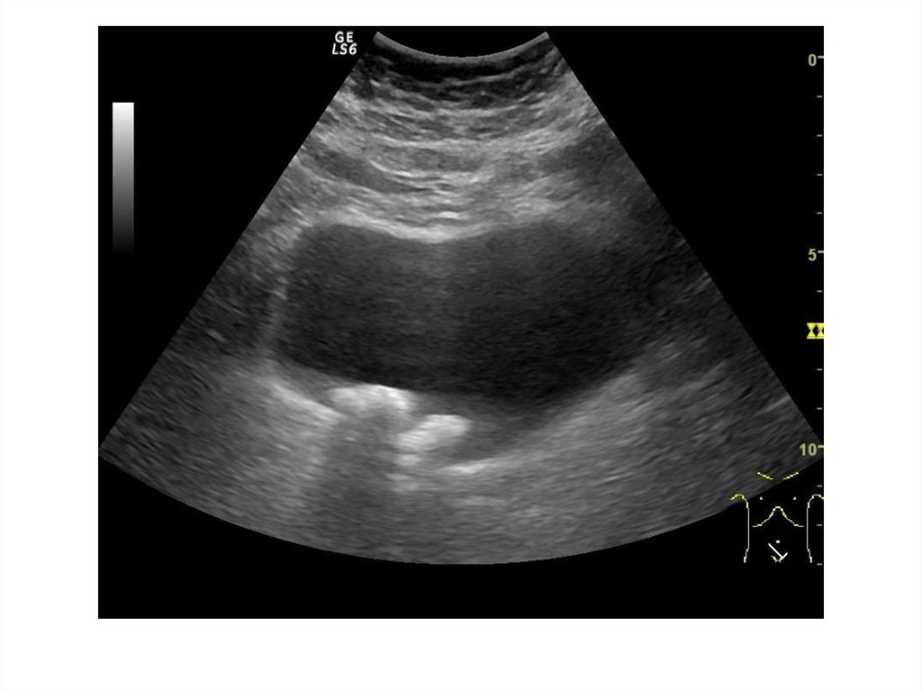 Камень в мочевом пузыре на узи фото