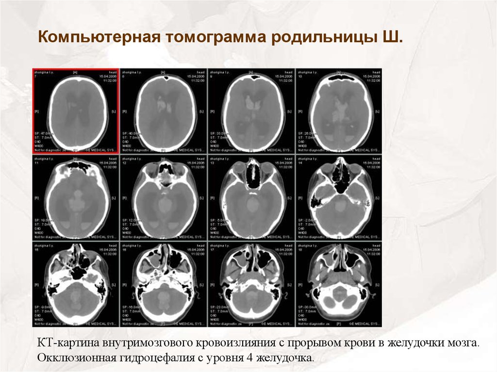 Кровоизлияние желудочка. Внутримозговое кровоизлияние с прорывом в желудочки кт. Окклюзионная гидроцефалия кт картина. Желудочки мозга на кт. Кровоизлияния в желудочки мозга кт.