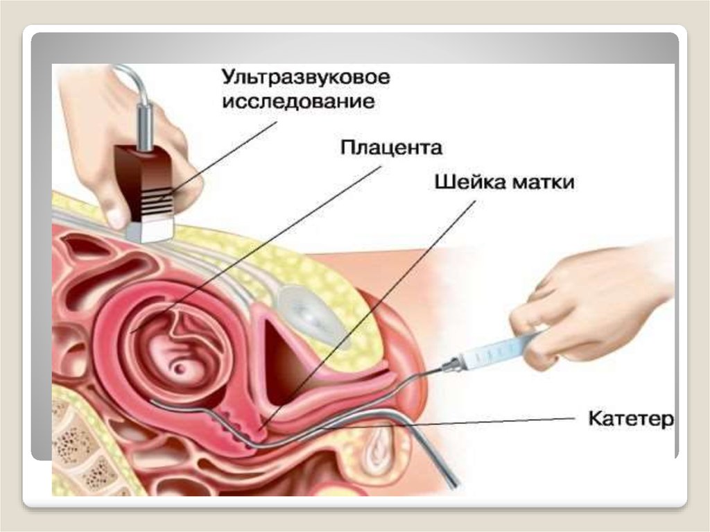 Диагностика матки. Инвазивный метод пренатальной диагностики. УЗИ метод пренатальной диагностики. Инвазивные методы исследования плода.