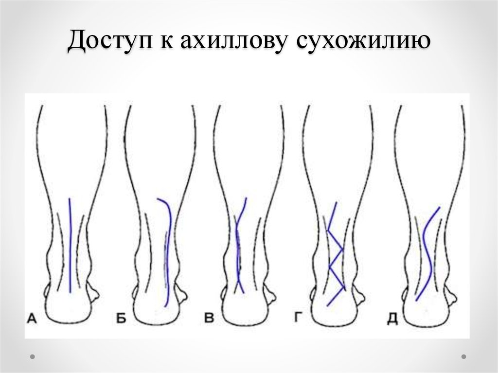 Ахиллово сухожилие фото где