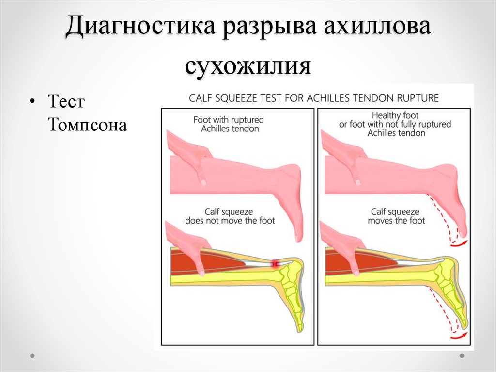 Разрыв ахиллова сухожилия фото