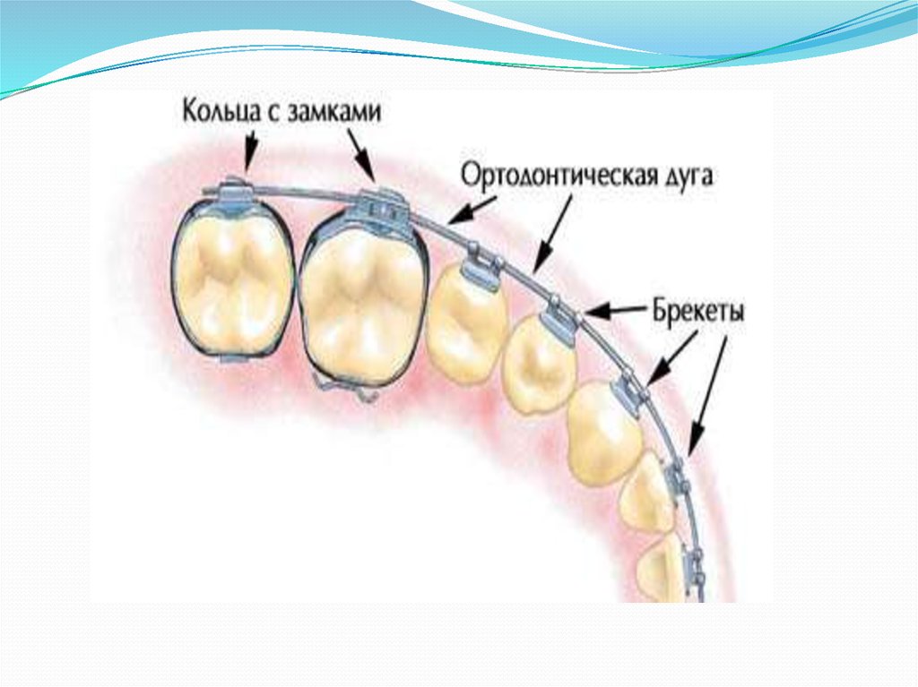 Активация брекет системы.