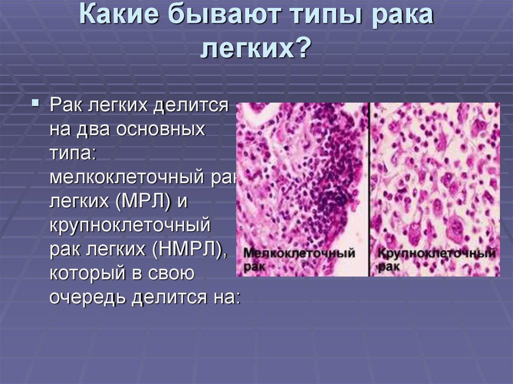 Рак легкого презентация по онкологии