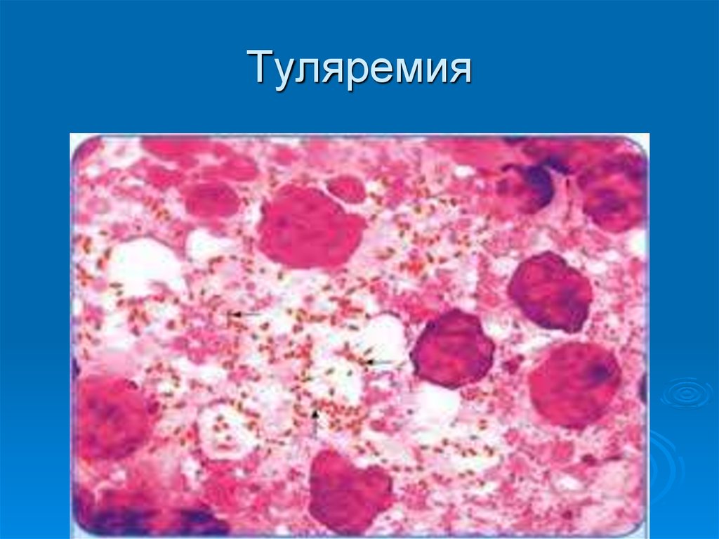 Туляремия картинки для презентации