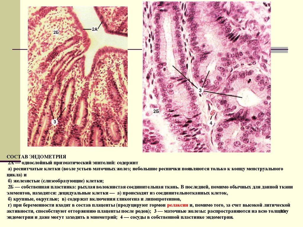 Эндометрий виды. Микропрепарата железистая гиперплазия эндометрия. Покровный эпителий эндометрия. Железистая гиперплазия эндометрия микропрепарат. Железистый эпителий эндометрия.