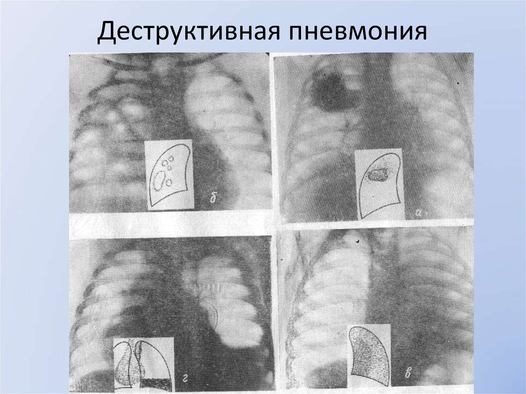 Деструктивная пневмония. Острая деструктивная пневмония у детей рентген. Деструктивная пневмония у детей рентген. Инфильтративно деструктивная пневмония. Инфильтративная форма деструктивной пневмонии.