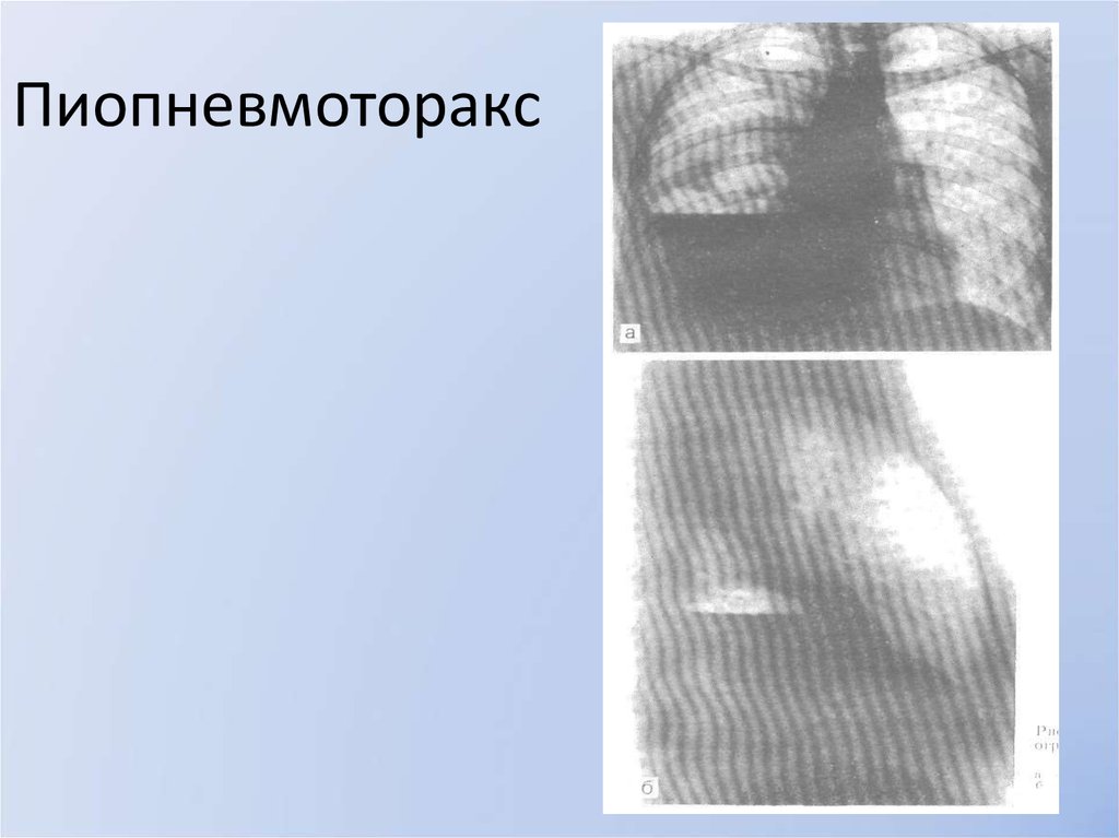 Пиопневмоторакс