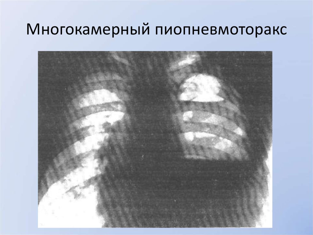 На рентгенологической картине напряженного пиопневмоторакса отмечается смещение средостения в