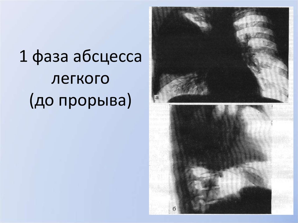 Рентгенологическая картина при абсцессе