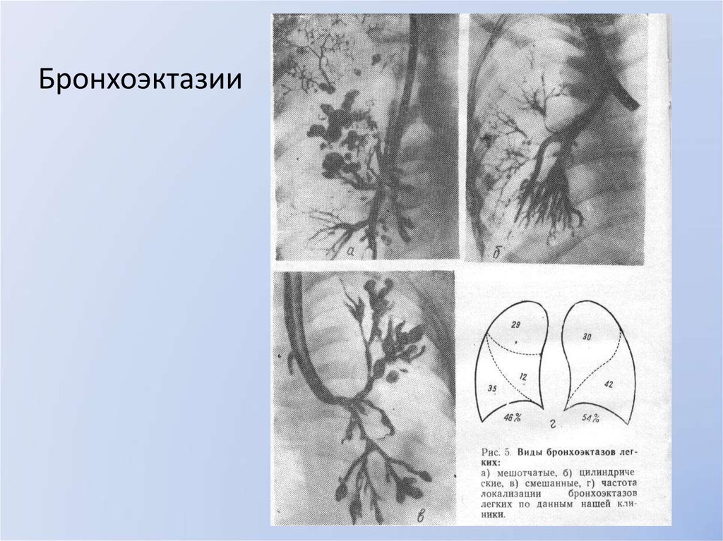 Бронхоэктатическая болезнь рисунки