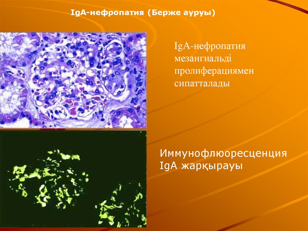 Берже болезнь презентация