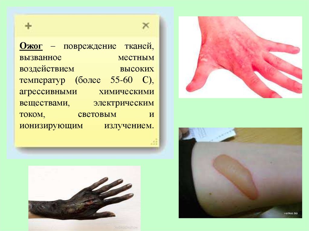 Ожог. Классификация ожогов - презентация онлайн