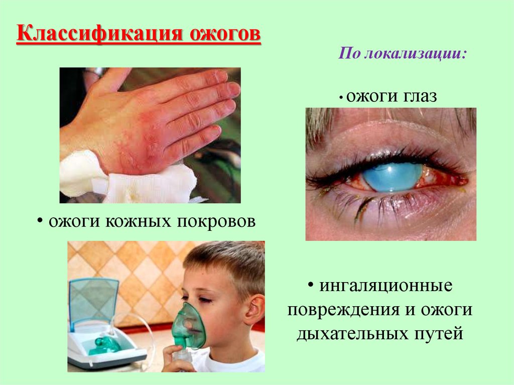 Ожог. Классификация ожогов - презентация онлайн