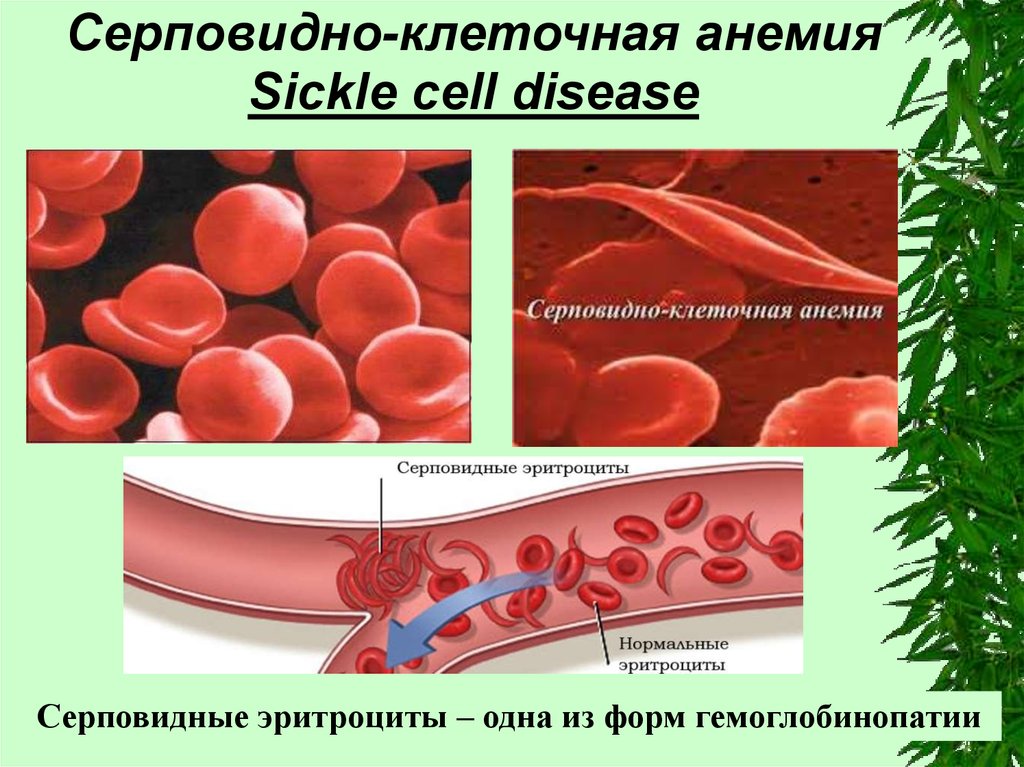 Серповидноклеточная анемия какая. Серповидноклеточная анемия (гемоглобинопатия). Серповидная анемия генное заболевание. Серповидноклеточная анемия Валин. Серповидно клеточная анемия эритроциты.